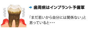 歯周病はインプラント予備軍