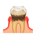 歯周病のある方